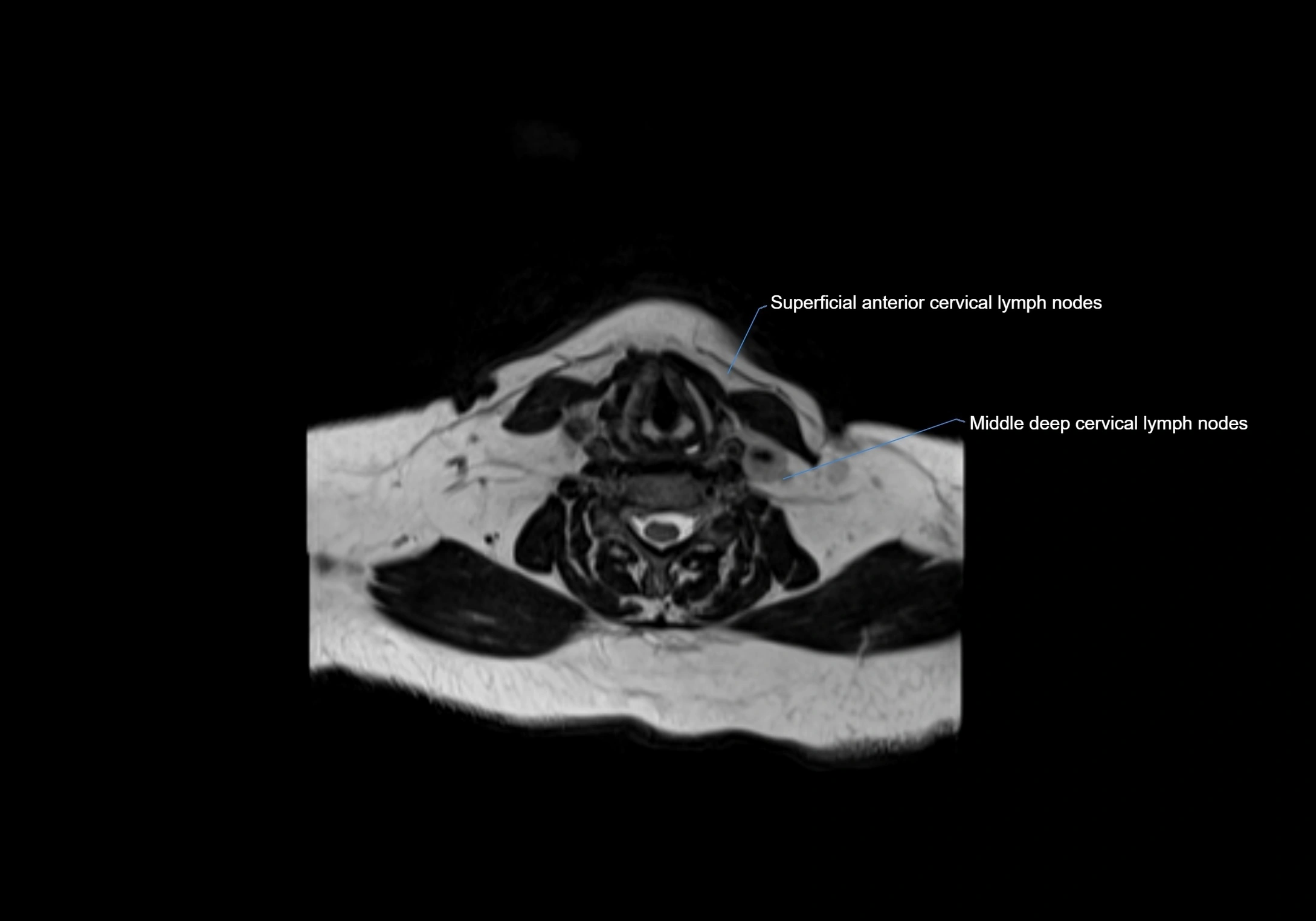 Neck axial  lymph node cross sectional MRI anatomy 3T MRI  image-img-00001-00067.webp